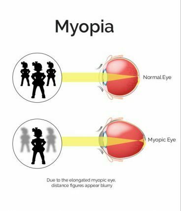 Diagram of myopia