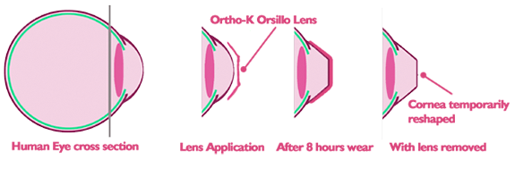 Ortho-K diagram