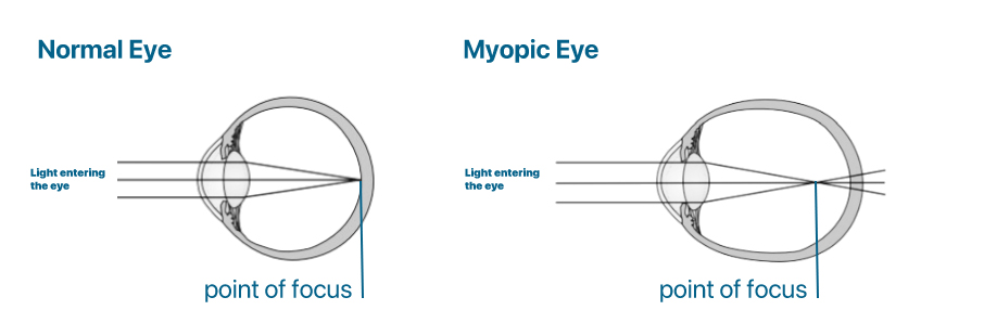 Myopic Eye